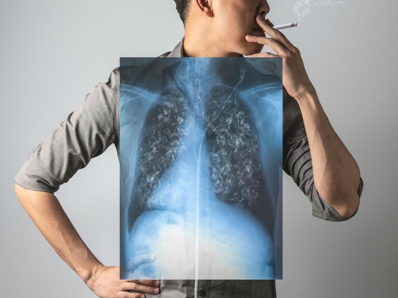 גבר מעשן סיגריה עם צילום רנטגן על החזה
