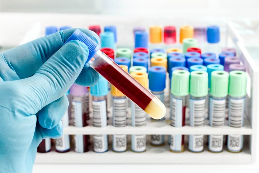 טכנאי מעבדה מחזיק מבחנה עם בדיקת דם