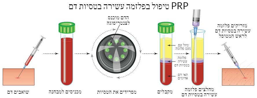 שלבי הטיפול בפלזמה עשירה בטסיות דם