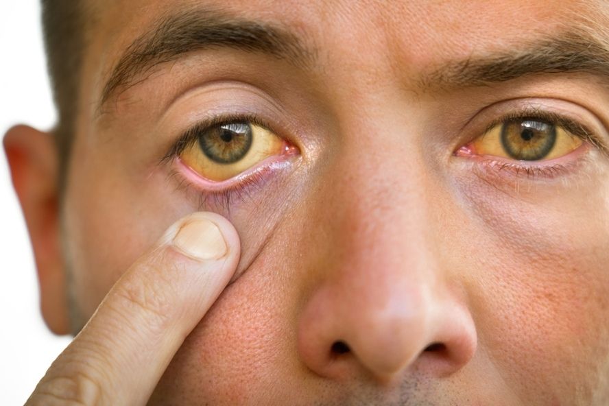 צהבהבות בעיניים - פגיעה בכבד עקב תרופות