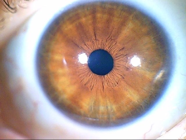 כתמים חומים בקשתית העין - אירידיולוגיה תמונה