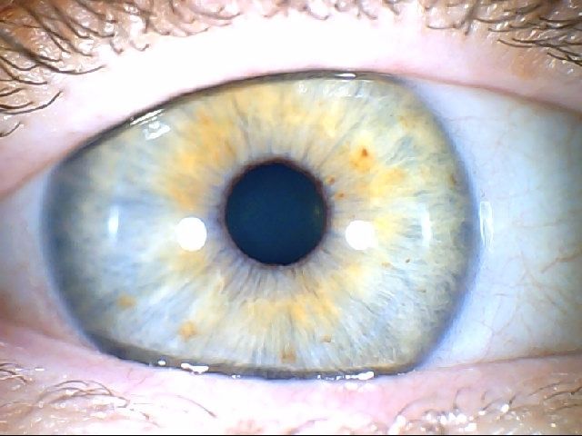 כתמים צהובים בקשתית העין - אירידיולוגיה תמונה